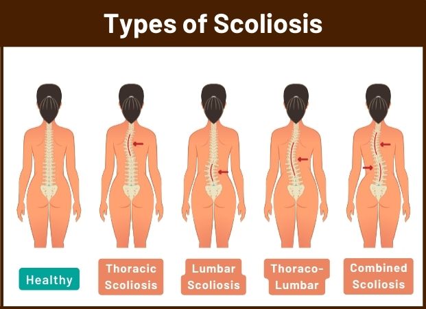 physical therapy scoliosis passaic
